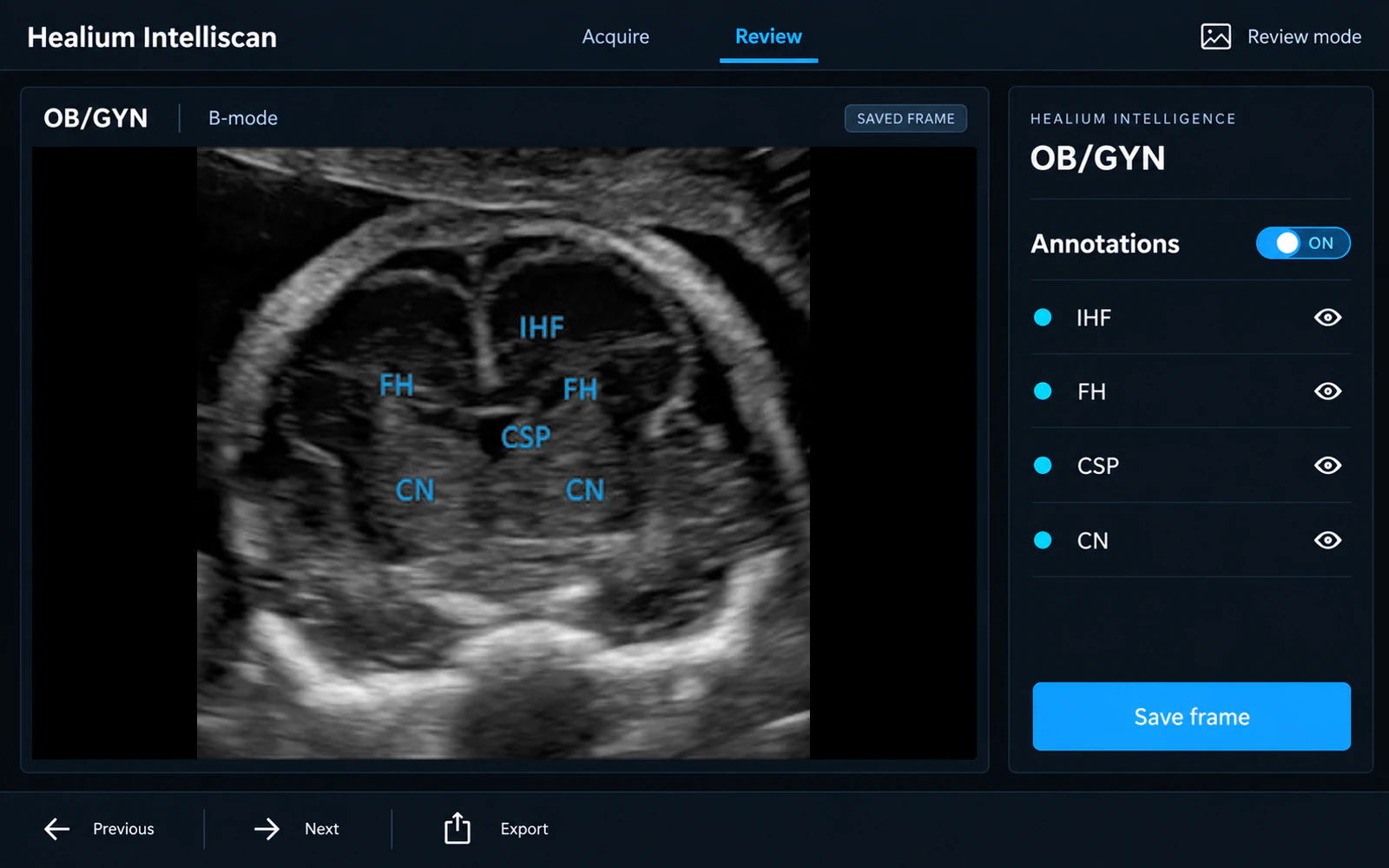 Healium Intelligence interface (in clinical evaluation): fetal head plane with Healium Intelligence labels IHF, FH, CSP and CN